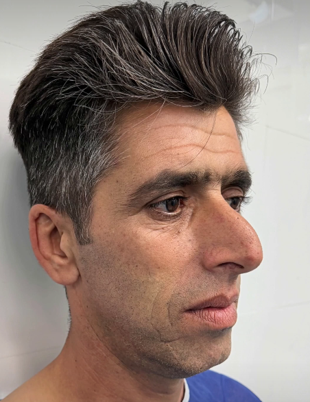 Ele mudou não apenas o nariz, mas toda a sua aparência… o novo penteado tornou a sua transformação ainda mais impressionante!
